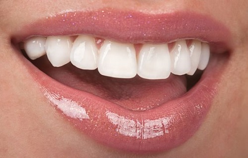 Răng sứ có trám được không? Cách khắc phục hiệu quả