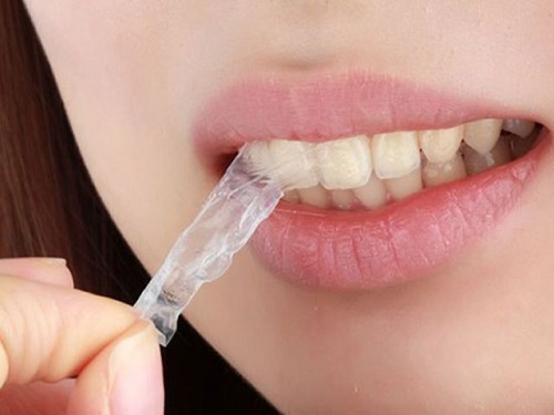 Tẩy trắng răng có ảnh hưởng gì không? Câu chuyện thực tế 2