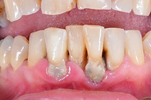 Lấy cao răng có đau hay không? Lý giải vấn đề này cho bạn 1