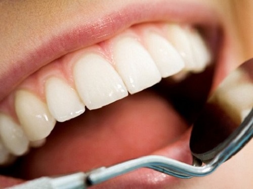 Lấy cao răng có đau hay không? Lý giải vấn đề này cho bạn 3 Lấy cao răng có đau hay không? Lý giải vấn đề này cho bạn 3