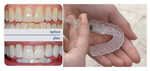 Chia sẻ cách sử dụng gel tẩy trắng răng an toàn 2