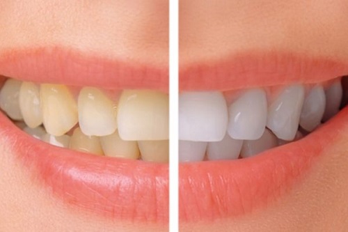 Tẩy trắng răng trong 1 tuần với những phương pháp nào? 1