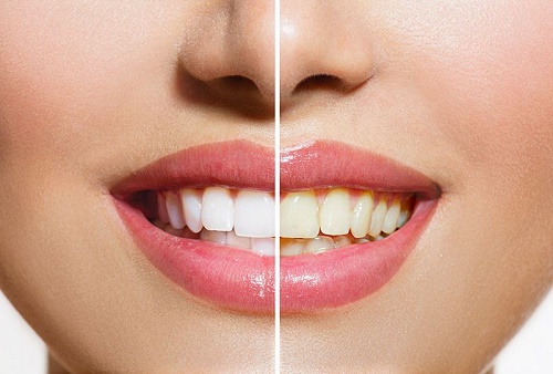  Có nên tẩy trắng răng nhiều lần không? Vì sao? 1