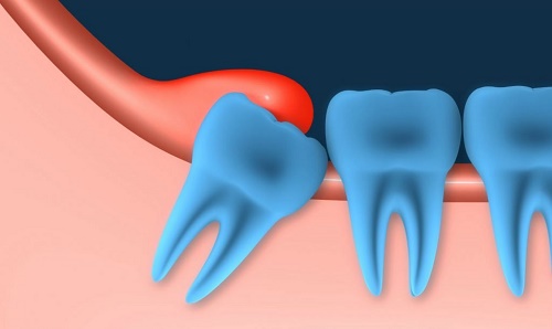 Điều trị viêm lợi trùm răng khôn bằng cách nào? 1
