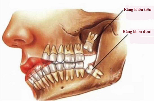 Cách điều trị sưng lợi ở răng khôn - Chấm dứt hiệu quả 1