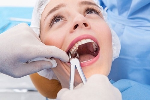 Có nên nhổ 2 răng khôn hàm trên một lần không? 3 Có nên nhổ 2 răng khôn hàm trên một lần không? 3