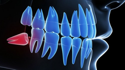 Răng khôn bị nhiễm trùng - Nguyên nhân và cách xử lý 1