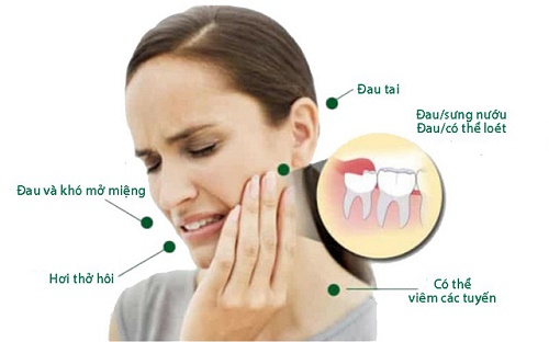 Răng khôn bị nhiễm trùng - Nguyên nhân và cách xử lý 2