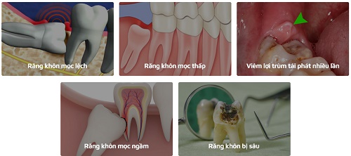 Răng khôn bị nhiễm trùng - Nguyên nhân và cách xử lý 3