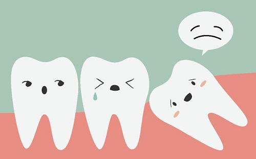Mọc 4 cái răng khôn cùng lúc cần lưu ý gì? 1