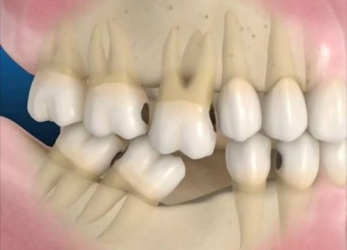 Trồng răng giả có lâu không? Tìm hiểu quy trình để biết chi tiết 1