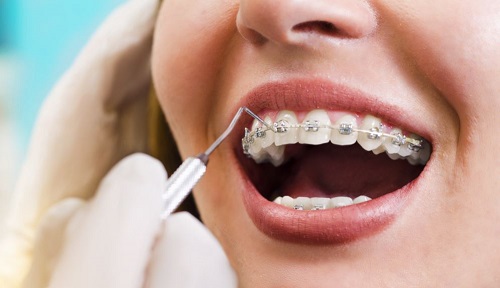 Trồng răng giả có niềng được không? Chuyên gia giải đáp 3
