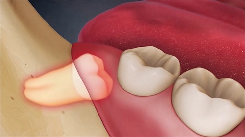 Răng khôn bị viêm do những nguyên nhân nào? 3