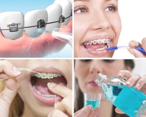 Niềng răng ăn cháo bao lâu thì ăn cơm bình thường được? 3 Niềng răng ăn cháo bao lâu thì ăn cơm bình thường được? 3
