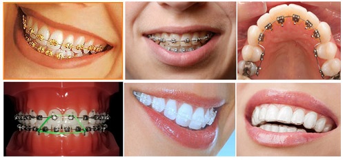 Niềng răng trả góp Cần Thơ - Hiệu quả chất lượng 4