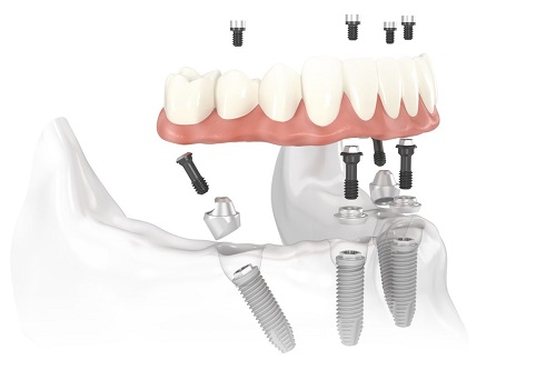 Trồng răng hàm implant giá bao nhiêu? Tham khảo chi tiết 1