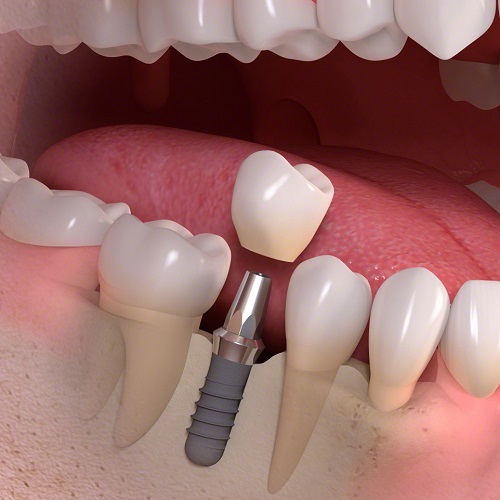 Trồng răng hàm implant giá bao nhiêu? Tham khảo chi tiết 2
