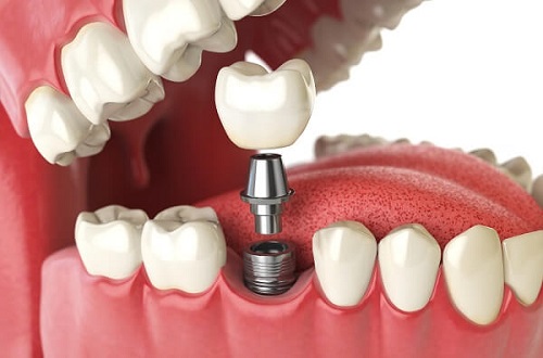 Trồng răng hàm implant giá bao nhiêu? Tham khảo chi tiết 3