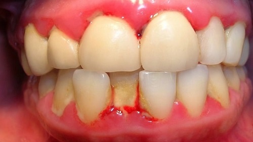 Niềng răng bị viêm lợi - Nguyên nhân do đâu? *