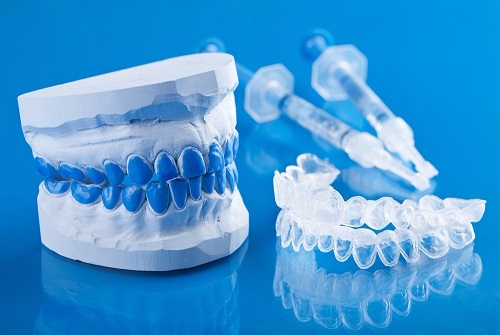 Tẩy trắng răng bằng máng bao nhiêu tiền? Chi phí trọn gói 1