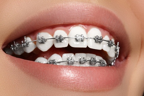 Cắm vít niềng răng bao lâu là xong? Tìm hiểu ngay 1