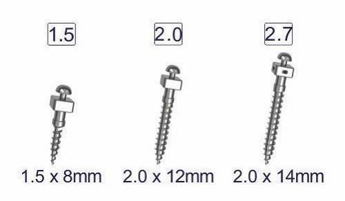 Cắm vít niềng răng bao lâu là xong? Tìm hiểu ngay 3