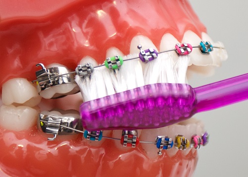 Niềng răng nên dùng bàn chải gì để vệ sinh hiệu quả? 2