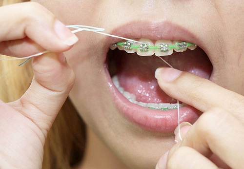Niềng răng nên dùng bàn chải gì để vệ sinh hiệu quả? 3