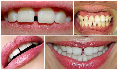 Trám răng bao lâu thì ăn được? Các lưu ý sau khi trám răng 2