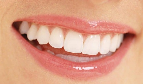 Bọc răng sứ ở đâu đẹp và hiệu quả? 1