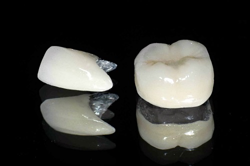 Bọc răng sứ titan có tốt không? Cần nắm bắt thông tin nào? 1 Bọc răng sứ titan có tốt không? Cần nắm bắt thông tin nào? 1