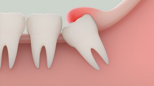 Răng khôn có bắt buộc phải nhổ? Tư vấn các trường hợp 1