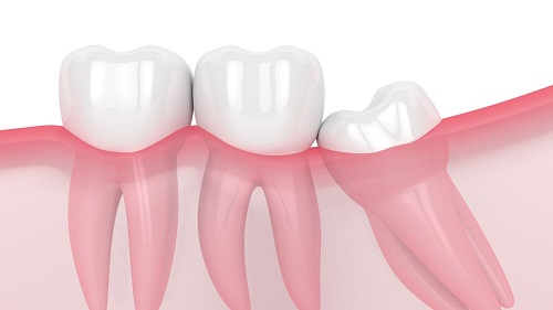 Răng khôn dị dạng là như thế nào? 2