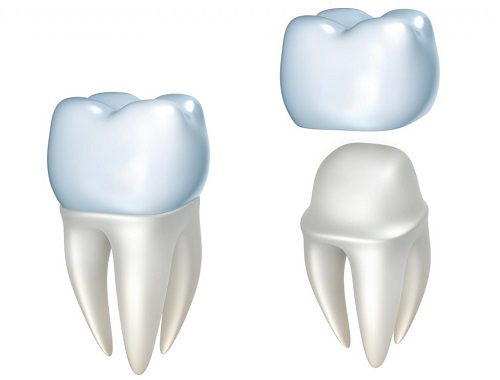 Chụp răng sứ giá bao nhiêu? Bật mí chi phí cho bạn 2