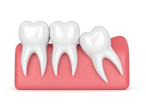 Răng khôn bị sâu có nên nhổ không? Bác sĩ tư vấn 1