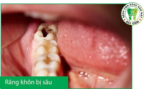Răng khôn bị sâu có nên nhổ không? Bác sĩ tư vấn 2