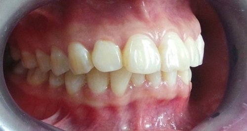 Niềng răng xong có bị hô lại không? Tìm hiểu thông tin 1