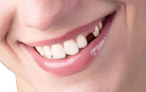 Trồng răng có chân răng với phương pháp nào? 1
