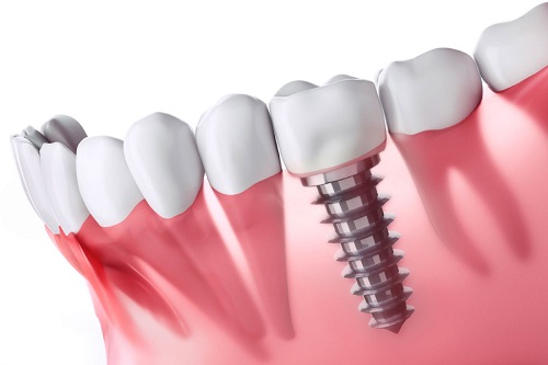Trồng răng có chân răng với phương pháp nào? 2