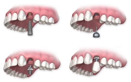 Trồng răng có chân răng với phương pháp nào? 3