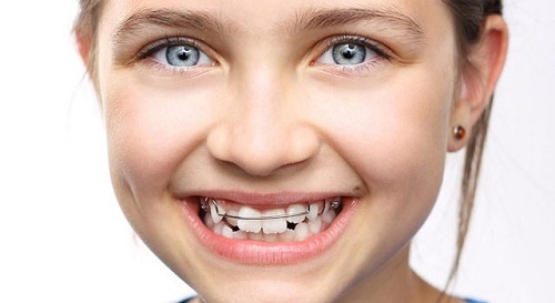 Niềng răng cho trẻ 10 tuổi - Các thông tin bạn cần biết 2
