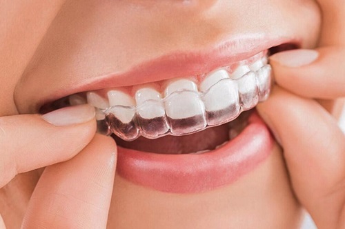 Niềng răng invisalign có nhổ răng không? Bác sĩ chuyên khoa giải đáp 2