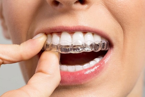 Niềng răng invisalign có nhổ răng không? Bác sĩ chuyên khoa giải đáp 3