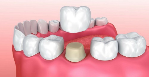 Bọc răng sứ có ảnh hưởng gì không? Tìm hiểu ngay 2