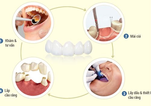 Bọc răng sứ có ảnh hưởng gì không? Tìm hiểu ngay 3