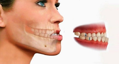 Niềng răng xong bị móm - Giải đáp lo lắng của khách hàng 2 Niềng răng xong bị móm - Giải đáp lo lắng của khách hàng 2
