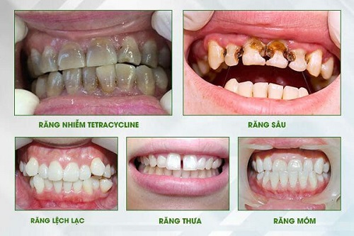 Bọc răng sứ giá rẻ cần lưu ý điều gì? 1 Bọc răng sứ giá rẻ cần lưu ý điều gì? 1