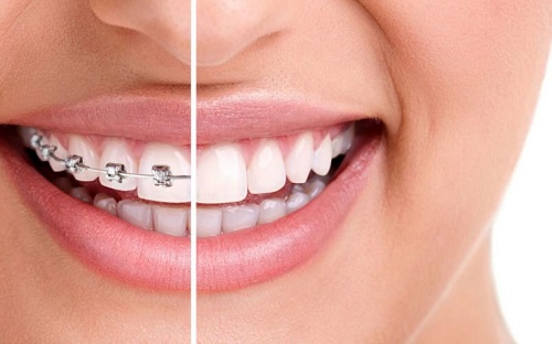 Niềng răng xong có nên tẩy trắng răng không? Lời khuyên từ nha khoa 1
