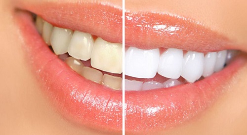 Niềng răng xong có nên tẩy trắng răng không? Lời khuyên từ nha khoa 2