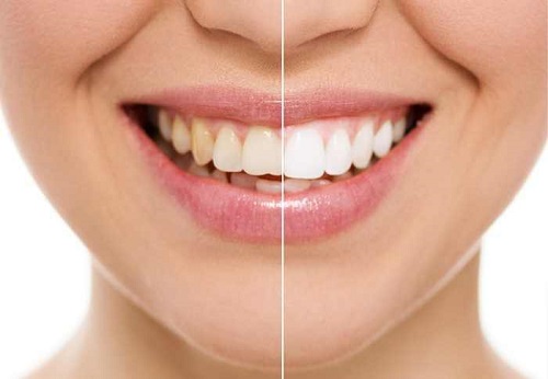 Tẩy trắng răng hút thuốc có sao không? Tham khảo từ nha khoa 1